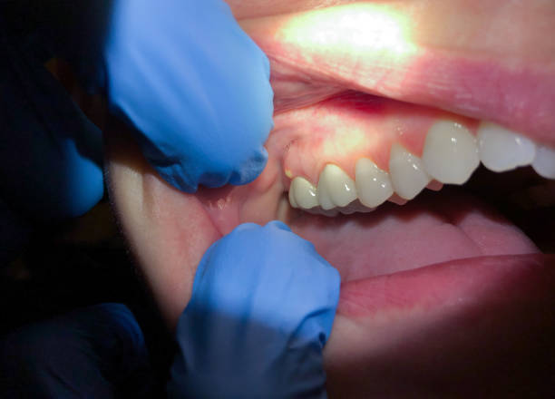 Best Urgent Tooth Repair  in Carthage, TX