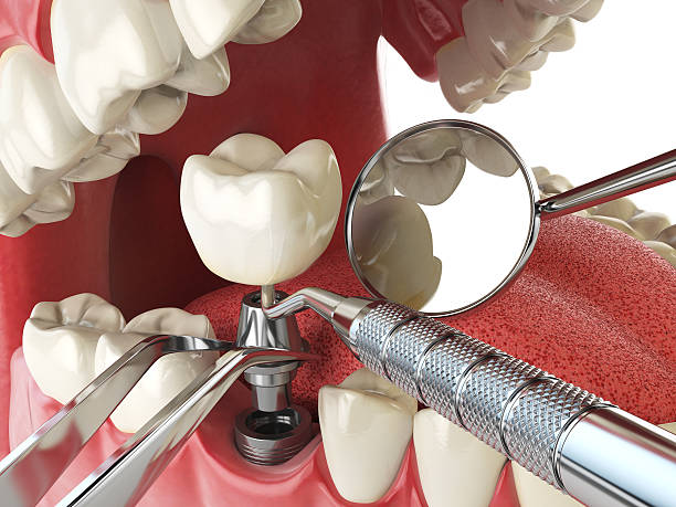 Best Root Canal Emergency Dentist  in Carthage, TX